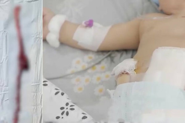 Өзбекстанда 10 айлық нәрестенің ішегі фастфудтың кесірінен шіріп кеткен